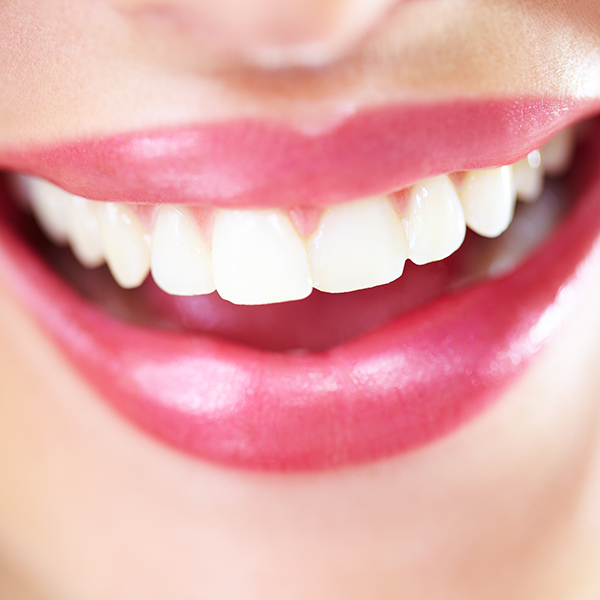 Close up of smile with veneers
